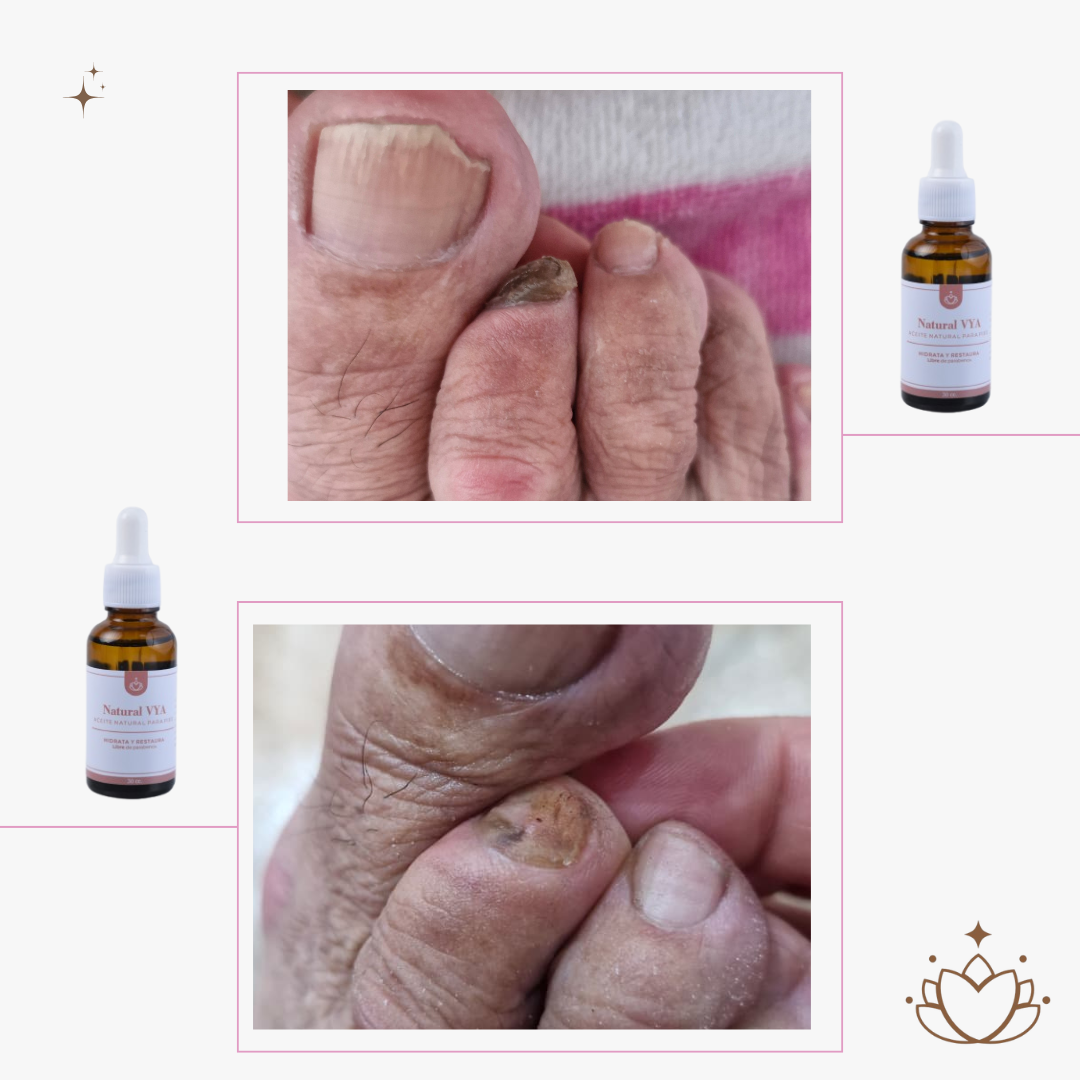 Aceite Antihongos para PIES 30ml.