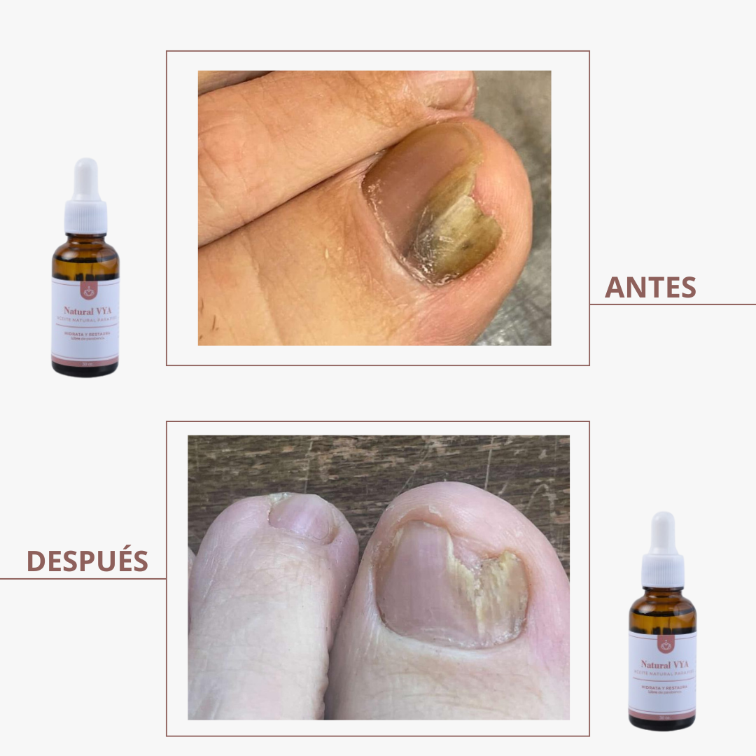Aceite Antihongos para PIES 30ml.