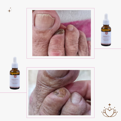 Aceite Antihongos para PIES 30ml.