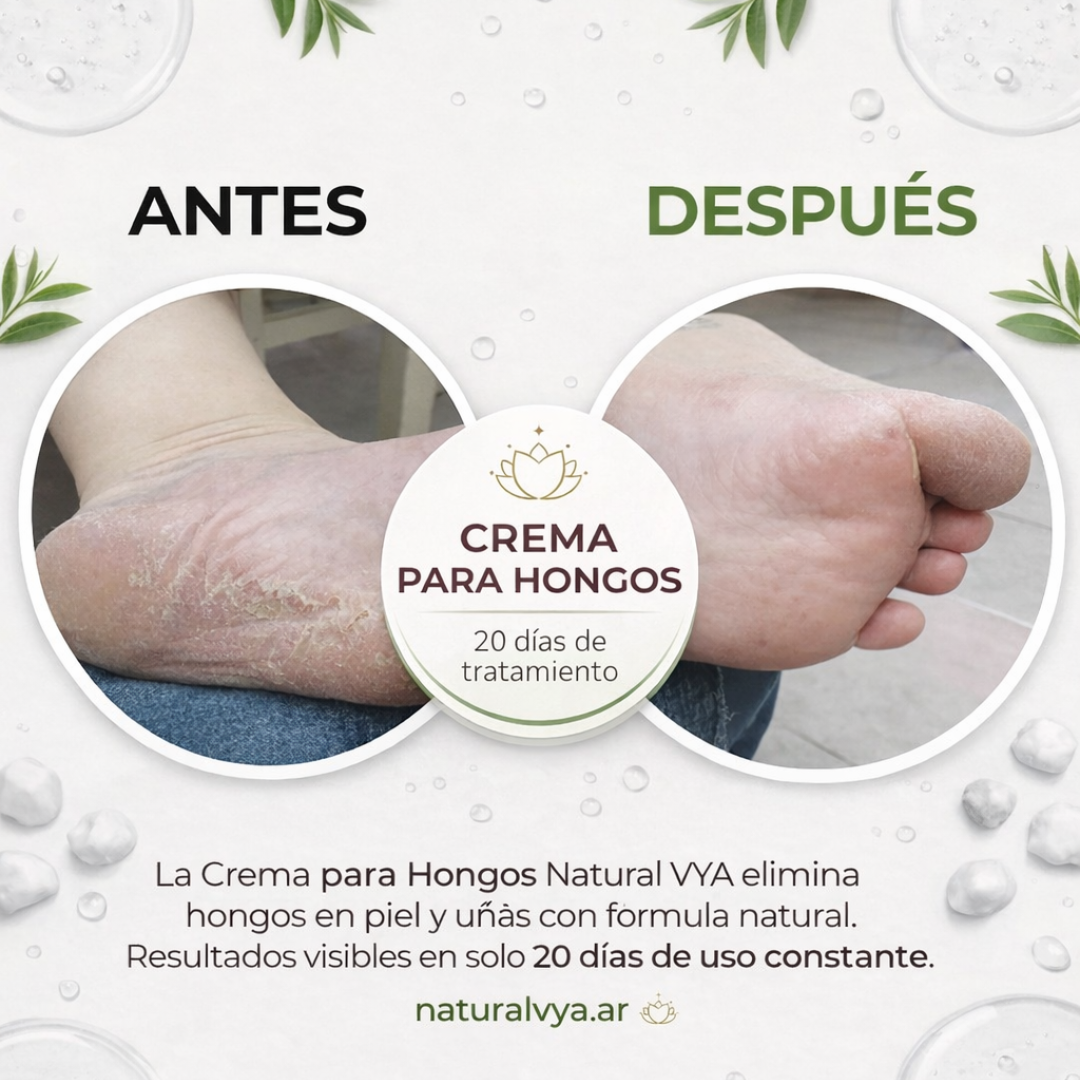 Crema para Hongos con Tea Tree 120ml.