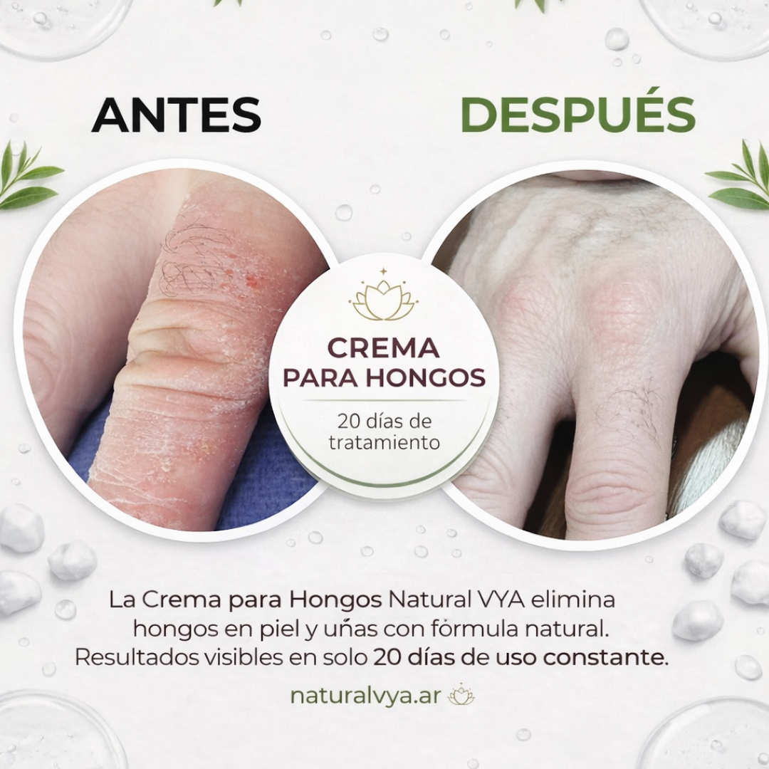 Crema para Hongos con Tea Tree 120ml.