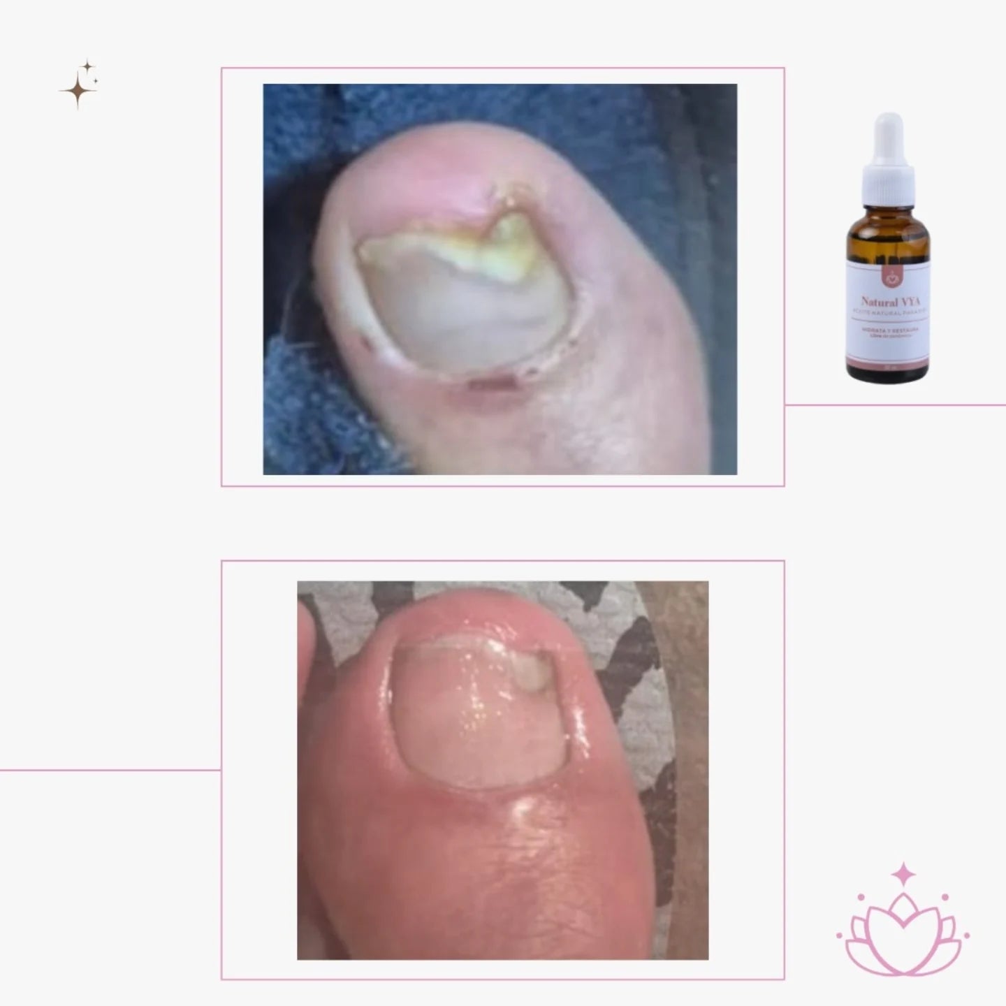 Aceite Antihongos para PIES 30ml.