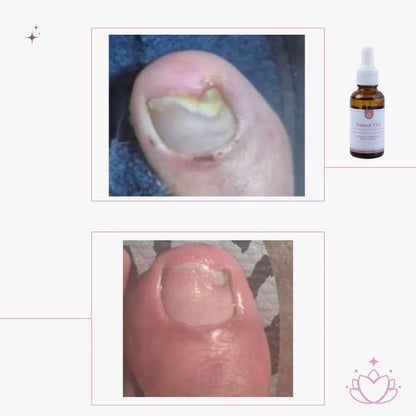 Aceite Antihongos para PIES 30ml.