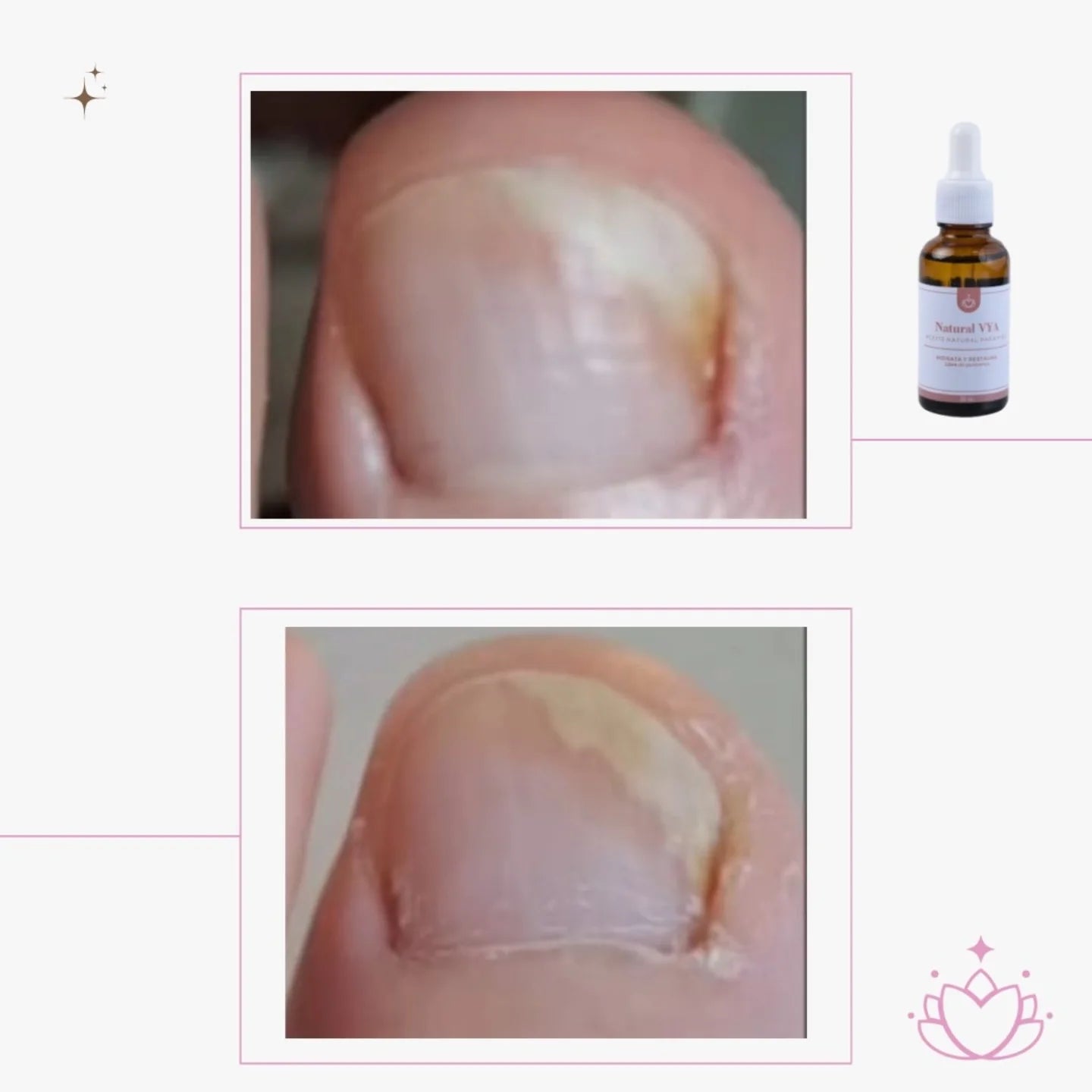 Aceite Antihongos 30ml. - MAYORISTA