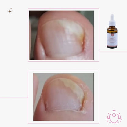 Aceite Antihongos 30ml. - MAYORISTA