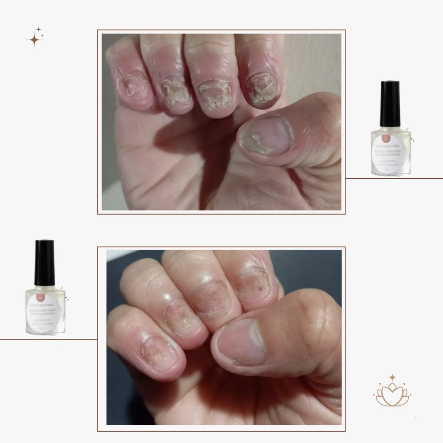 Laca AntiHongos de Manos - 10ml MAYORISTA